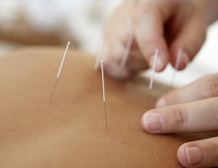 Иглорефлексотерапия - Санаторий «Летцы»