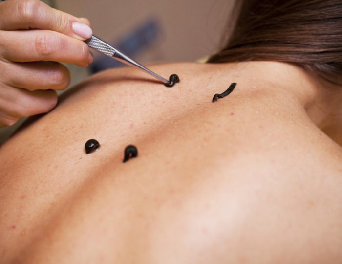 Гирудотерапия - Санаторий «Летцы»